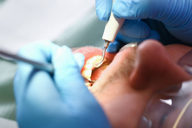 Best Broken or Chipped Tooth Repair in Holley, NY